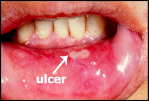 mouth ulcers